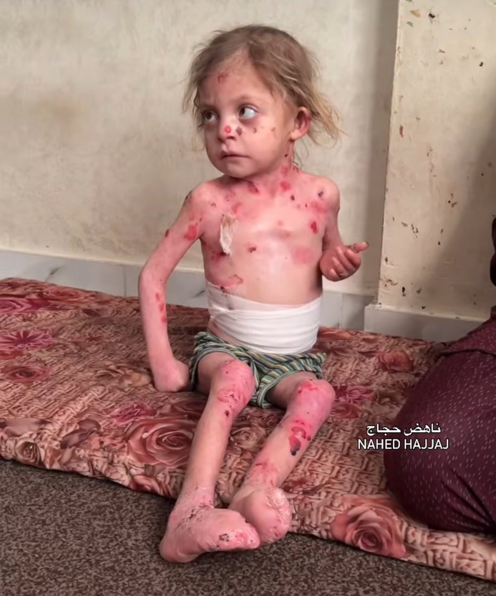 Help Nour al-Huda Hajjaj: Urgent Plea to Save Young Lives! — Nour al-Huda medical emergency, rare skin disease treatment, urgent travel for sick children, humanitarian aid for children, critical health conditions 2025
