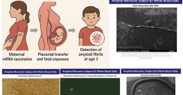 "Shocking Discovery: Amyloid Fibrils in Toddler Linked to mRNA Shot"  mRNA vaccine safety, pediatric chronic illness, prenatal exposure effects