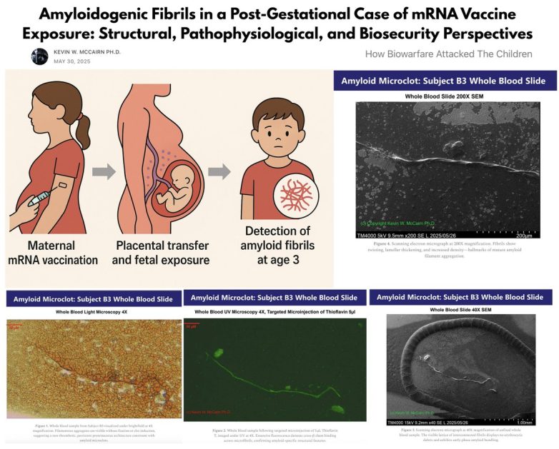 "Shocking Discovery: Amyloid Fibrils in Toddler Linked to mRNA Shot"  mRNA vaccine safety, pediatric chronic illness, prenatal exposure effects
